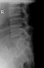 Abdominal aortic aneurysm