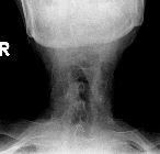 Ankylosing spondylitis