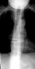 Ankylosing spondylitis with fracture T8/T9