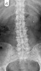 Diffuse metastases