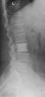 Ivory vertebra L3