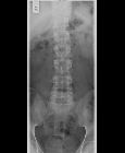 Normal lumbar spine