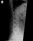 Normal lumbar spine