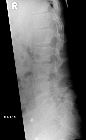 Spondylolisthesis L5/S1 with pars defect