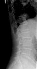 Spondylosis lumbar spine