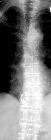 Spondylosis thoracic spine
