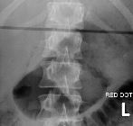 Fracture left L1 transverse process. Overlying bowel gas right L1 transverse process