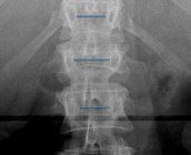 Abnormal interpedicular distance due to burst fracture