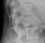 Convex posterior vertebral body cortex due to burst fracture