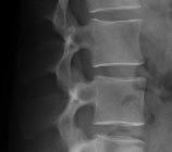 Normal lumbar spine