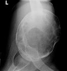 Aneurysmal bone cyst - proximal humerus