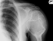 Aneurysmal bone cyst - proximal humerus