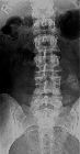 Chondrosarcoma - transverse processes L4