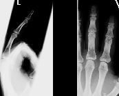 Enchondroma with pathological fracture