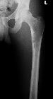 Fibrous dysplasia - femur