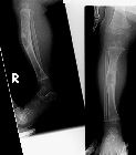 Fibrous dysplasia - tibia, with pathological fracture