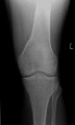 Giant cell tumour - distal femur