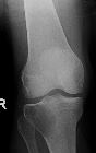 Giant cell tumour - proximal tibia