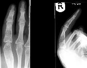 Ollier's disease with pathological fracture