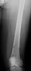 Multiple myeloma - femur