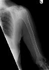 Multiple myeloma - humerus