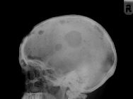 Multiple myeloma - skull