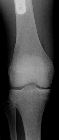 Non-ossifying fibroma - distal femur