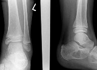 Solitary bone cyst - calcaneum