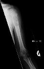 Solitary bone cyst - proximal humerus with fracture