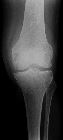 Bone infarct - distal femur