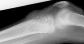 Osteomyelitis - proximal tibia