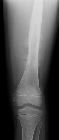 Osteosarcoma - 9 year old with sunburst periosteal reaction