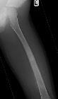 Osteosarcoma - 9 year old with sunburst periosteal reaction