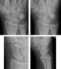 Fracture distal pole scaphoid