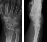 Triquetral fracture