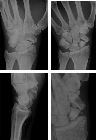 AVN proximal pole of scaphoid