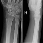 Radial styloid fracture