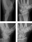 Fracture trapezium, fracture triquetral