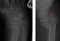 Volar type Barton's - fracture volar rim radius (and ulna) with anterior subluxation radiocarpal joint