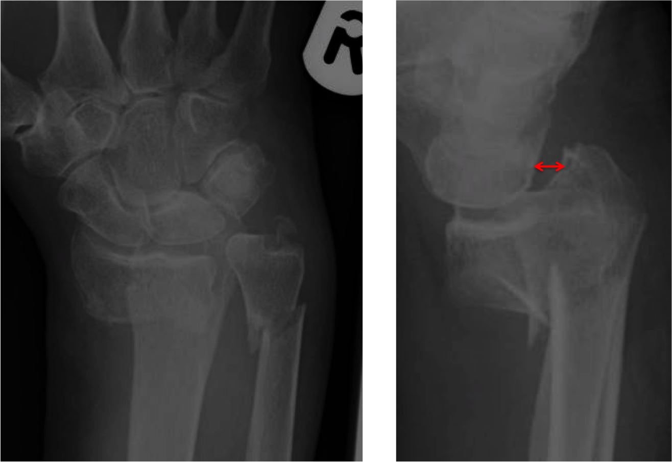 Volar barton fracture