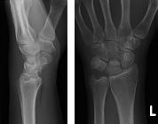 Comminuted fractures proximal capitate and lunate, with impaction and rotation