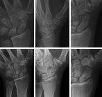 Scaphoid - fracture demonstrated on follow up images (bottom)