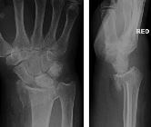 Smith's fracture